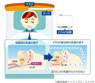 閉塞時の気道の様子、CPAP療法時の軌道の様子 ©株式会社フィリップス・ジャパン